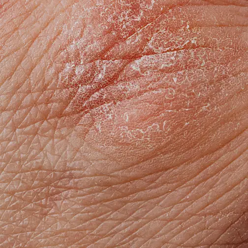 Dry, red and flaking skin caused by eczema