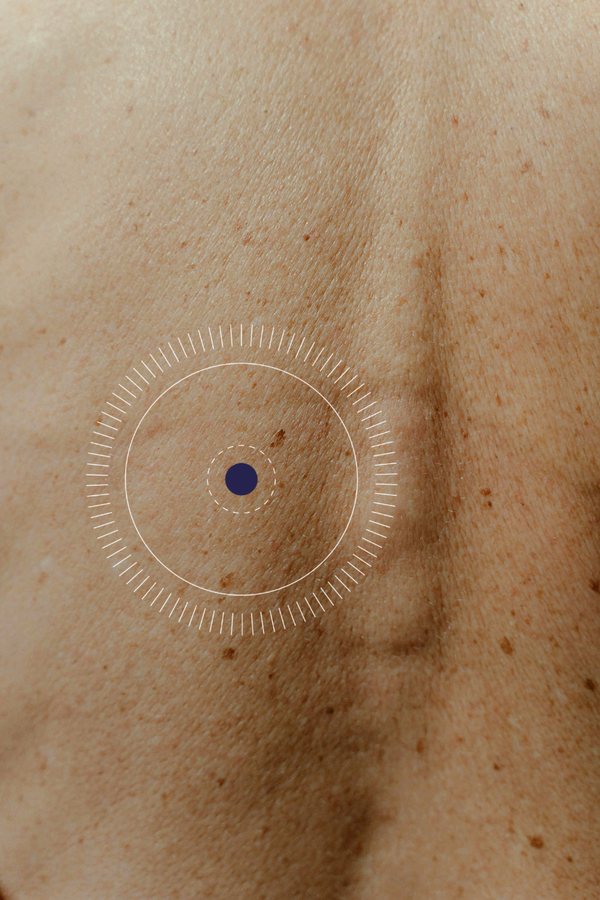 Close-up of freckled skin with a highlight marker around a spot