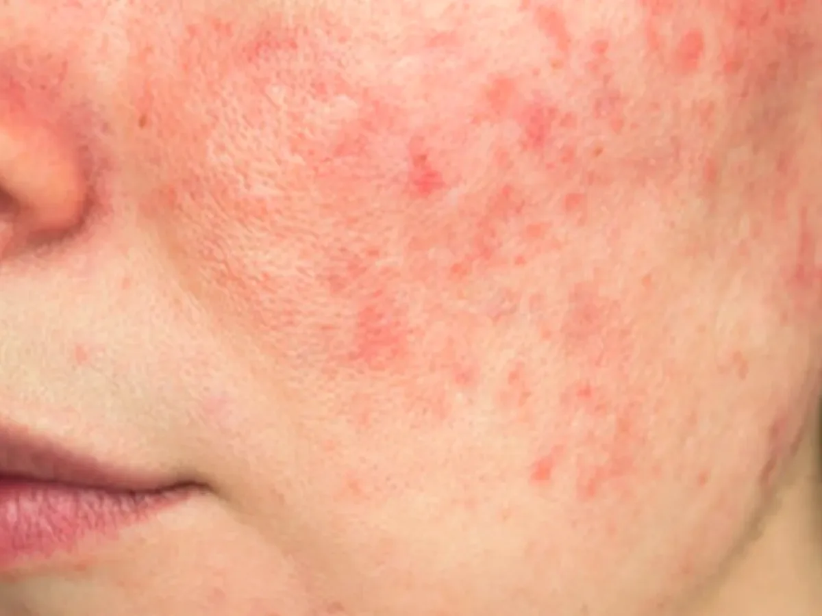 Jawline with deep painful acne bumps