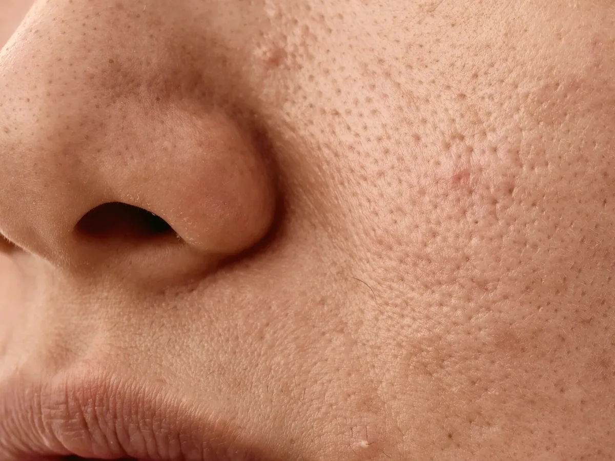 Close-up of skin with blackheads and small bumps
