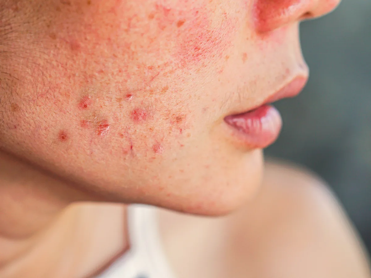Cheek with red inflamed pimples