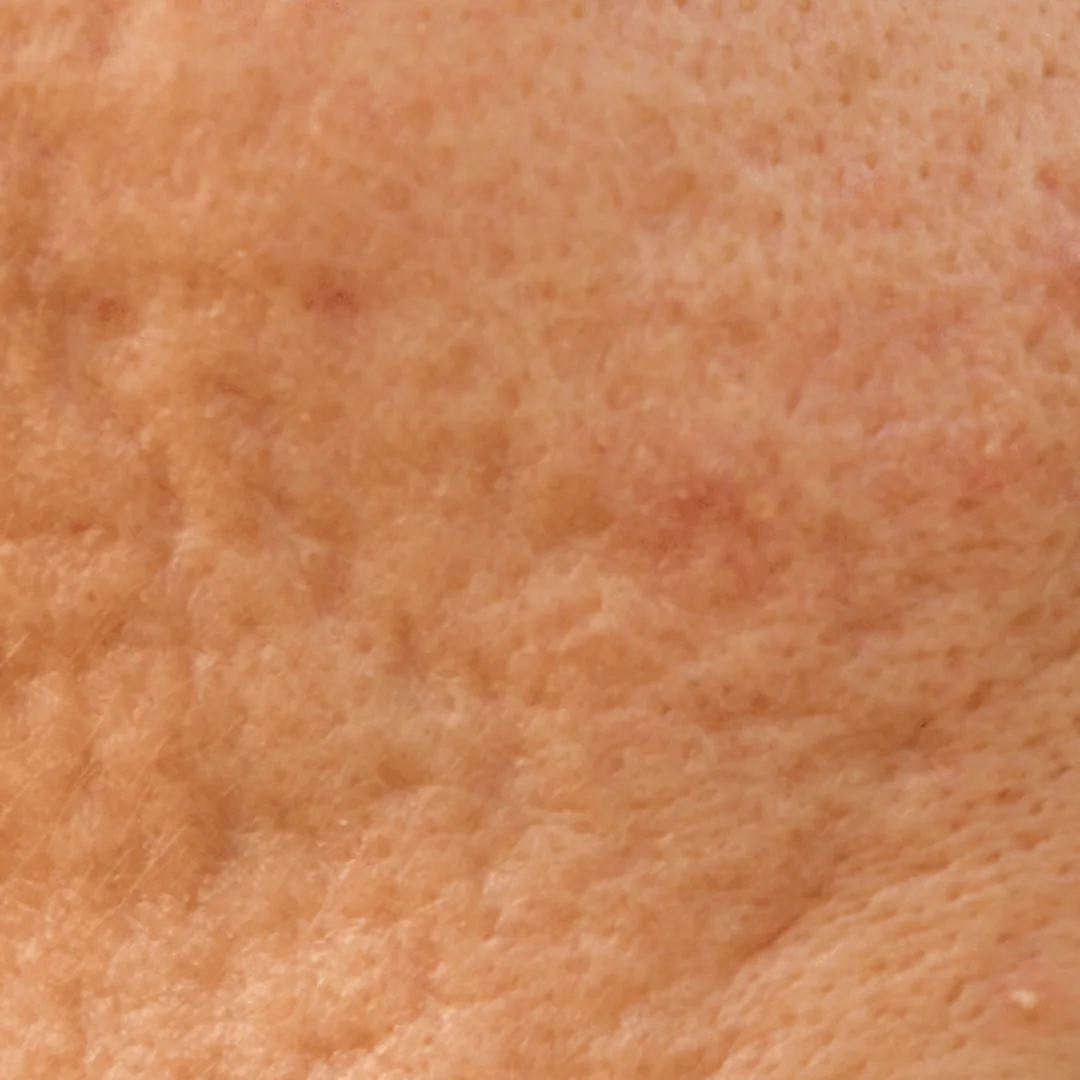 Close-up of a cheek with depressed acne scars