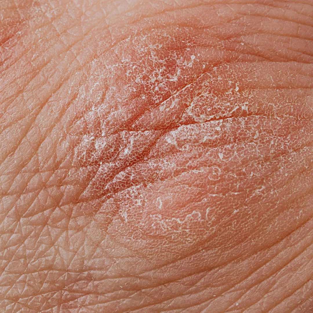 Close-up van droge, geïrriteerde huid met fijne schilfers