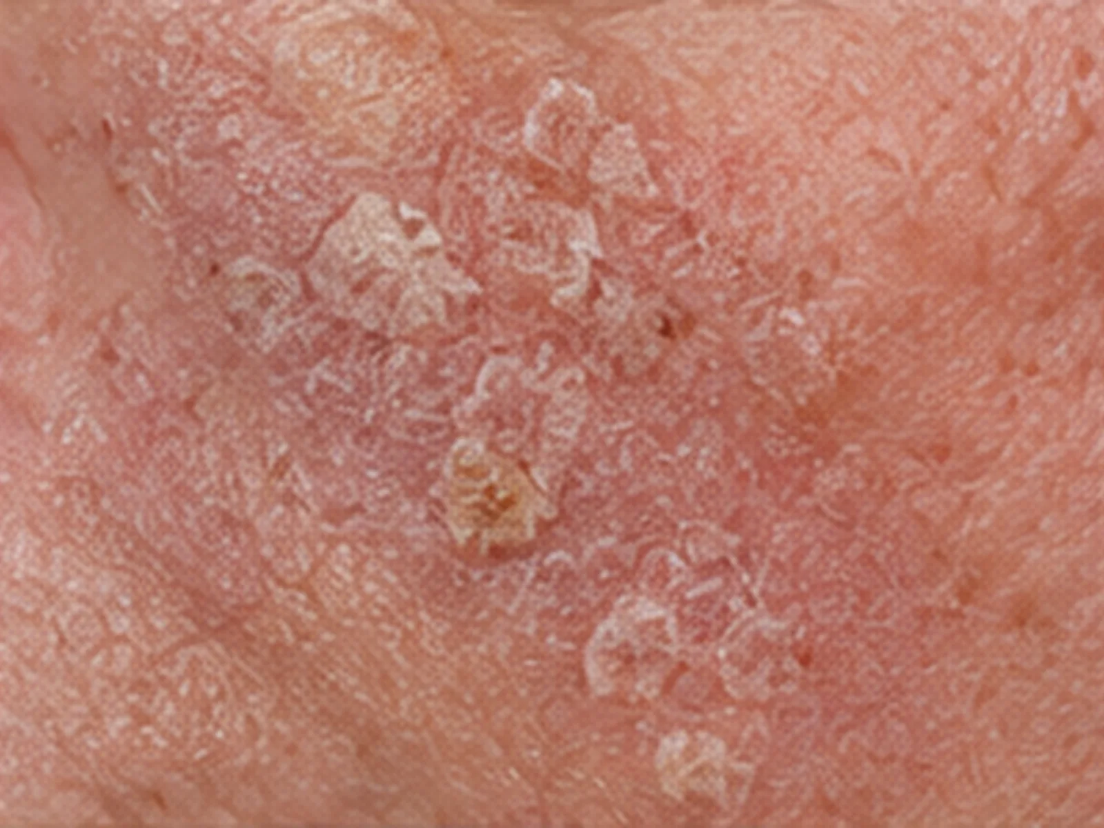 Actinic keratosis close up