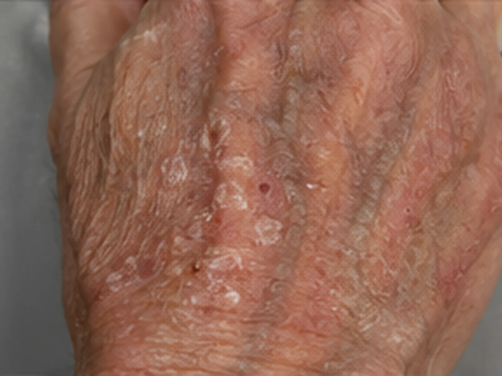 Actinic keratosis on the back of the hand