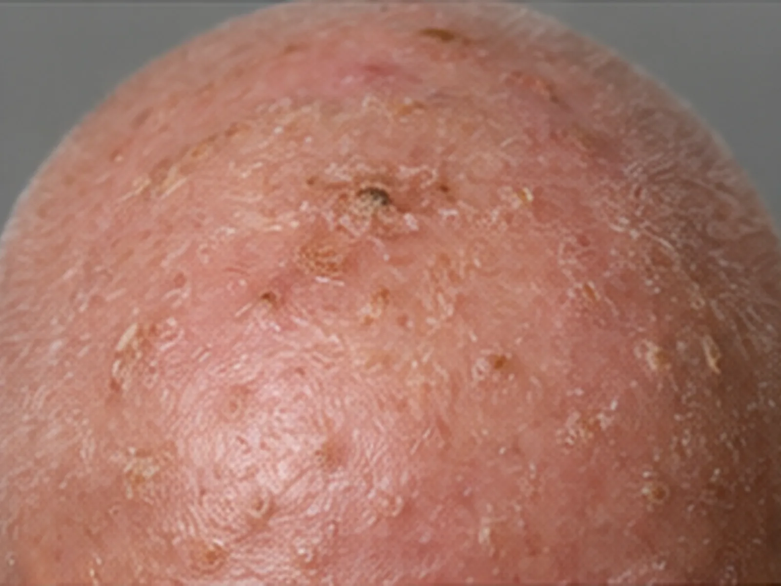 Actinic keratosis on a bald scalp