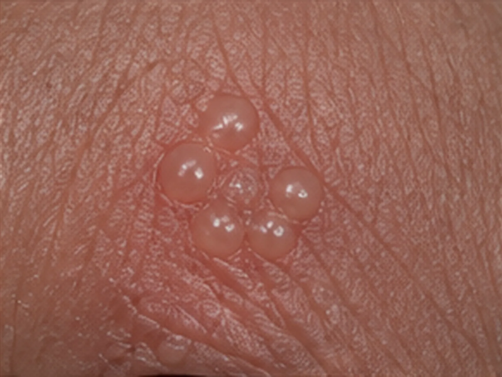 Genital herpes, blister stage