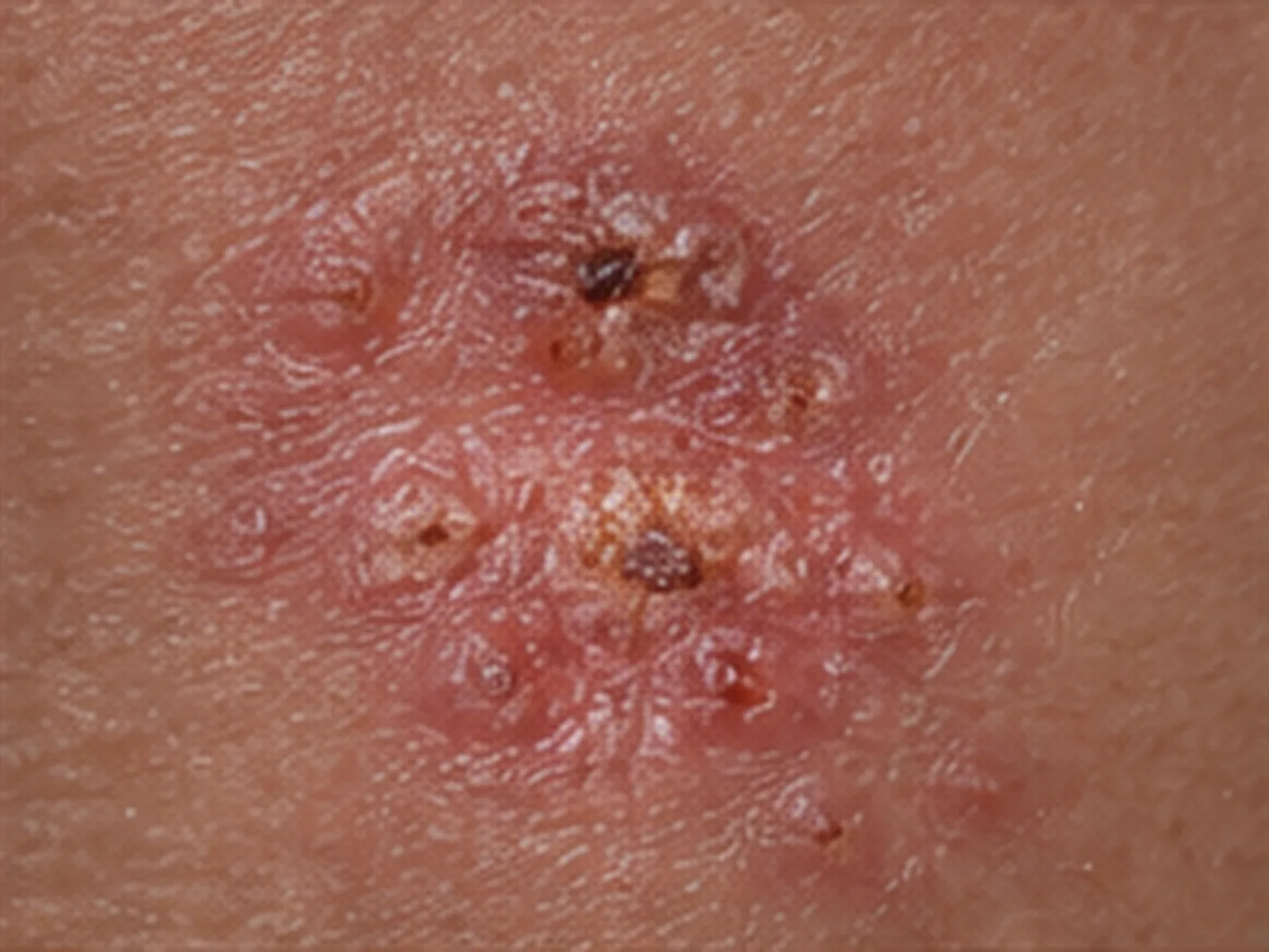 Genital herpes, crusts and small sores