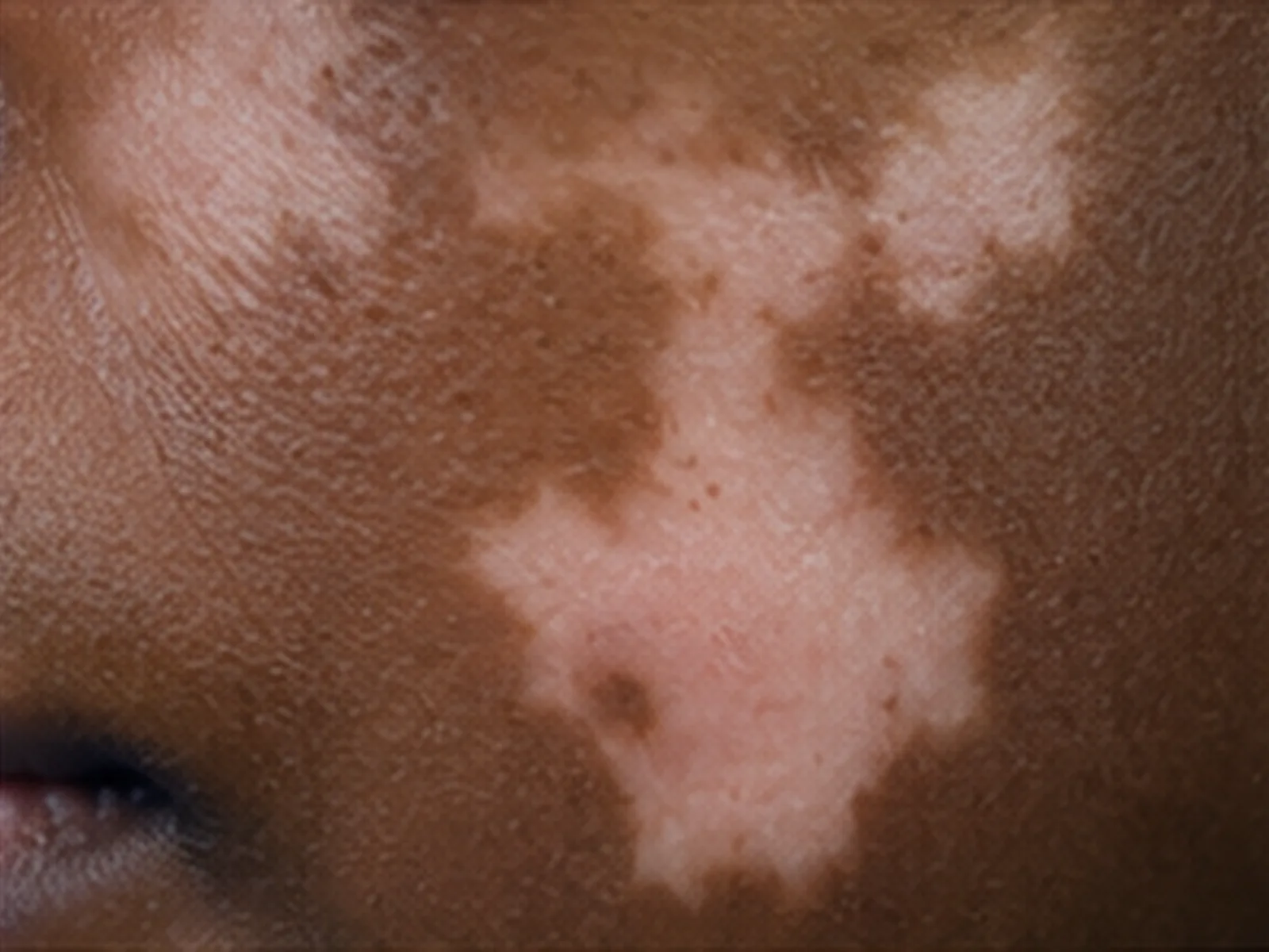 Vitiligo op de wang bij een donkere huid