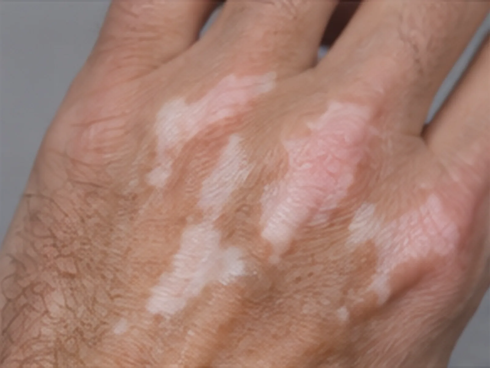 Vitiligo: witte vlekken op de handrug