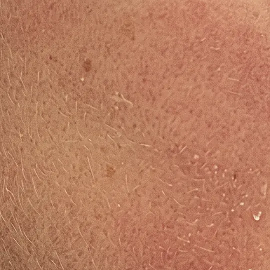 Close-up of dry, lightly flaking skin with fine hairs
